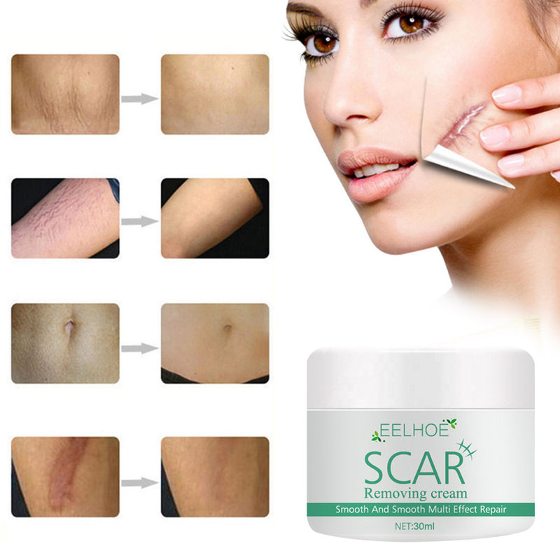 Skin Smoothing And Repairing Cream For Scalding And Burn Scars