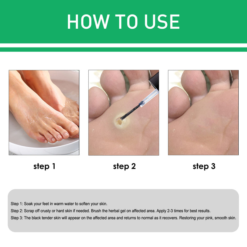 Wart Removal Corns Smoothing Skin Gentle Foot Care Solution